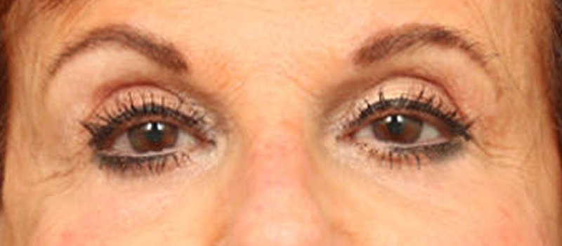 Brow / Temple Lift Before & After Image