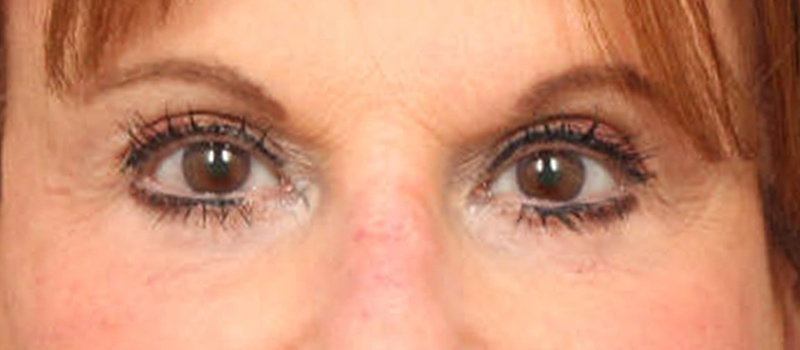Brow / Temple Lift Before & After Image