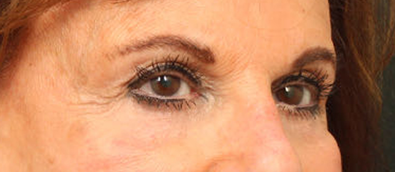 Brow / Temple Lift Before & After Image