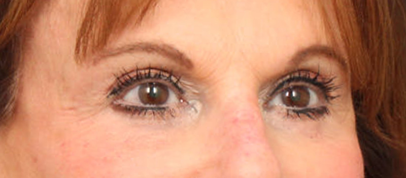 Brow / Temple Lift Before & After Image