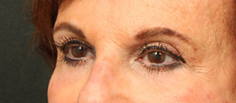 Brow / Temple Lift Before & After Image