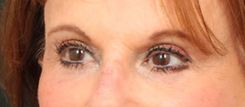 Brow / Temple Lift Before & After Image