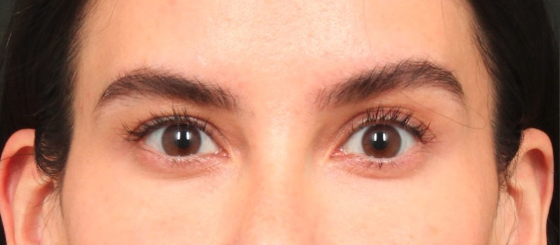 Brow / Temple Lift Before & After Image