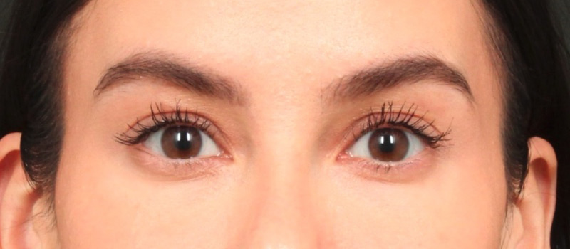 Brow / Temple Lift Before & After Image