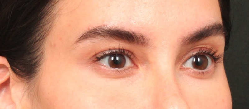 Brow / Temple Lift Before & After Image