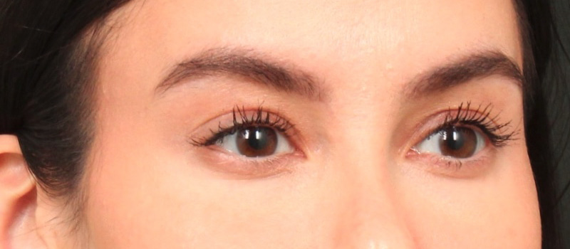 Brow / Temple Lift Before & After Image