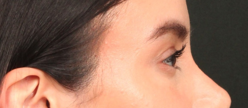 Brow / Temple Lift Before & After Image