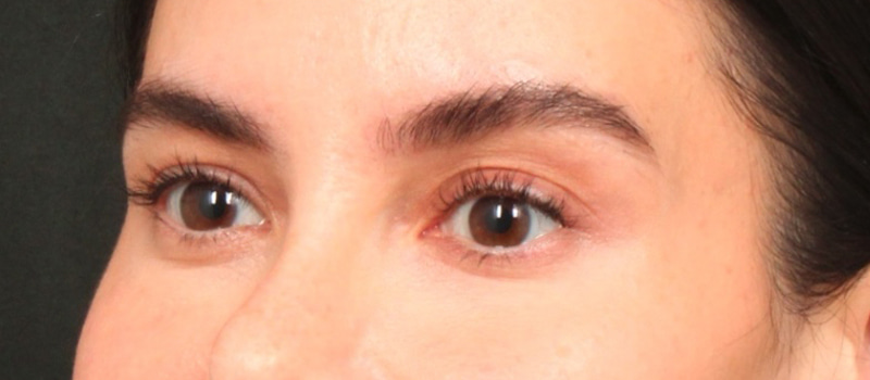 Brow / Temple Lift Before & After Image