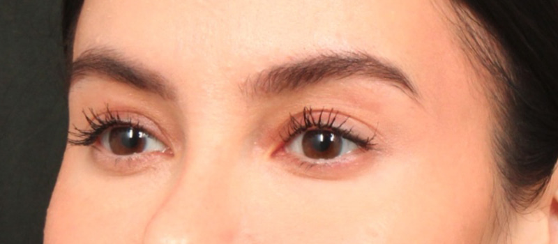 Brow / Temple Lift Before & After Image