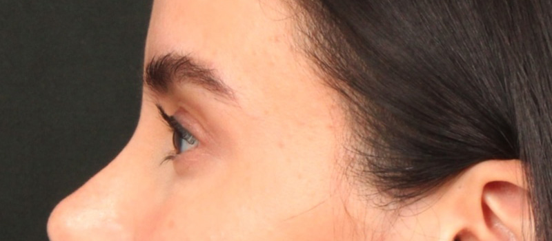 Brow / Temple Lift Before & After Image