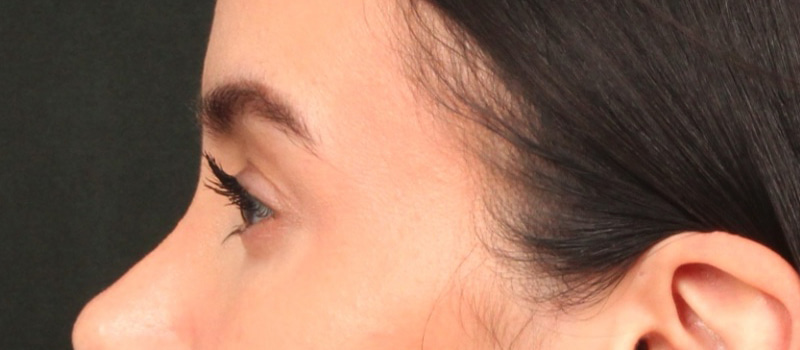 Brow / Temple Lift Before & After Image