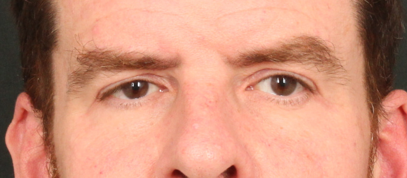Brow / Temple Lift Before & After Image