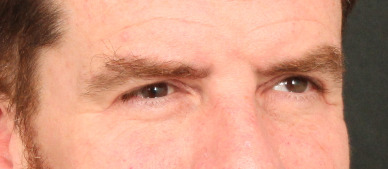 Brow / Temple Lift Before & After Image