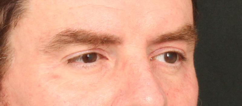 Brow / Temple Lift Before & After Image