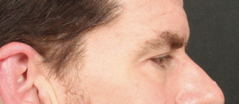 Brow / Temple Lift Before & After Image