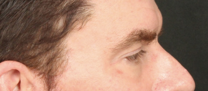Brow / Temple Lift Before & After Image