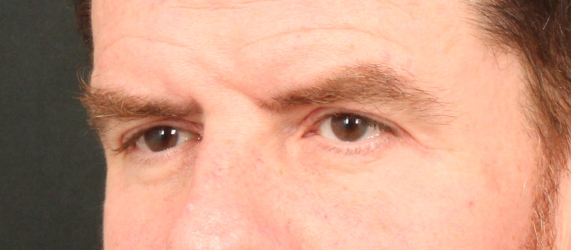 Brow / Temple Lift Before & After Image