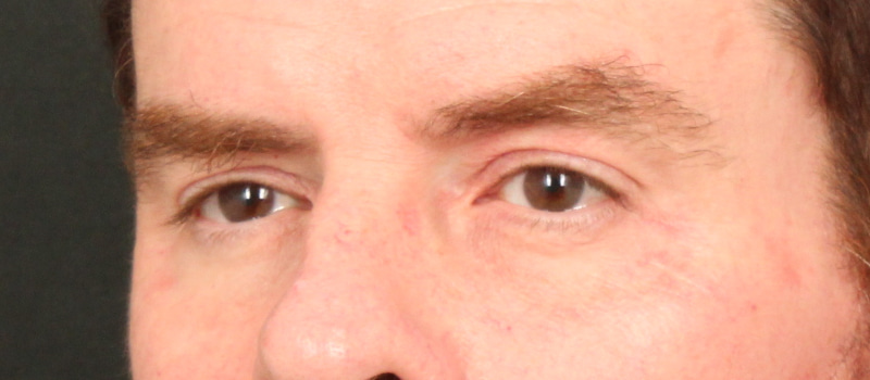 Brow / Temple Lift Before & After Image