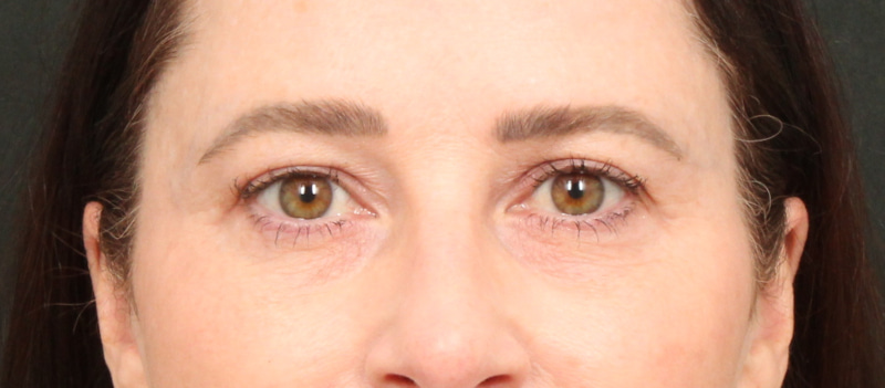 Brow / Temple Lift Before & After Image