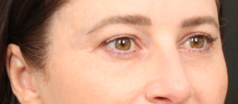 Brow / Temple Lift Before & After Image