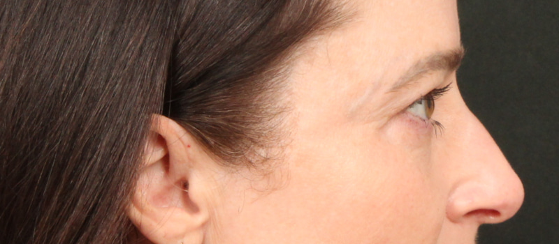 Brow / Temple Lift Before & After Image