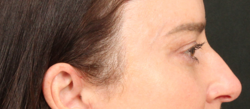 Brow / Temple Lift Before & After Image