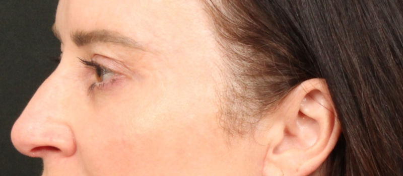 Brow / Temple Lift Before & After Image