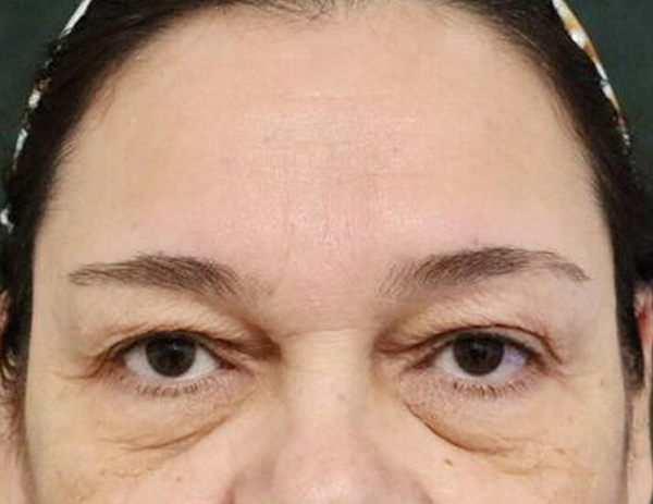 Lower Blepharoplasty Before & After Image