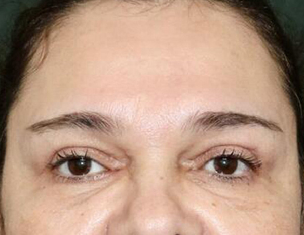 Lower Blepharoplasty Before & After Image