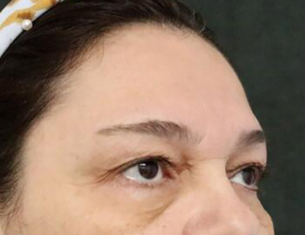 Lower Blepharoplasty Before & After Image