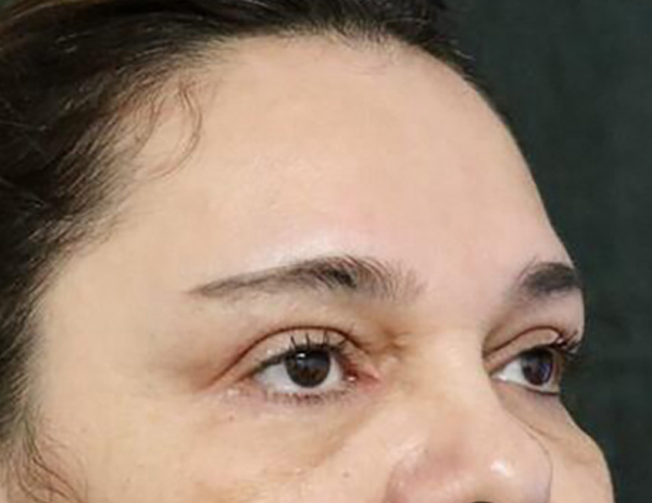 Lower Blepharoplasty Before & After Image