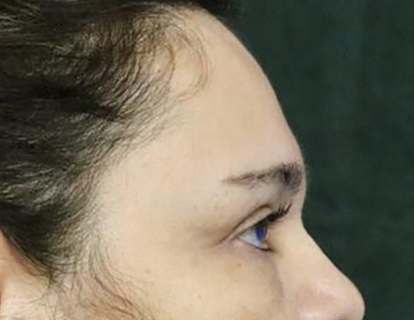 Lower Blepharoplasty Before & After Image