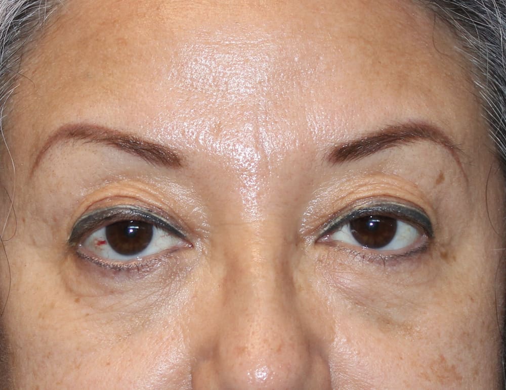 Lower Blepharoplasty Before & After Image