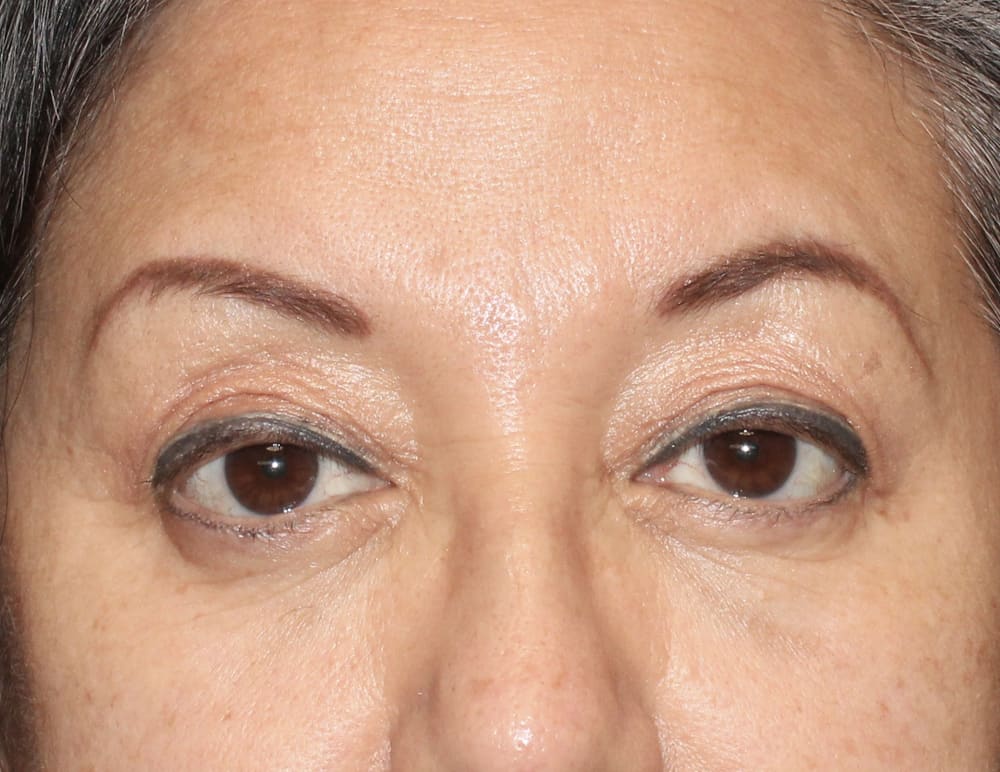 Lower Blepharoplasty Before & After Image