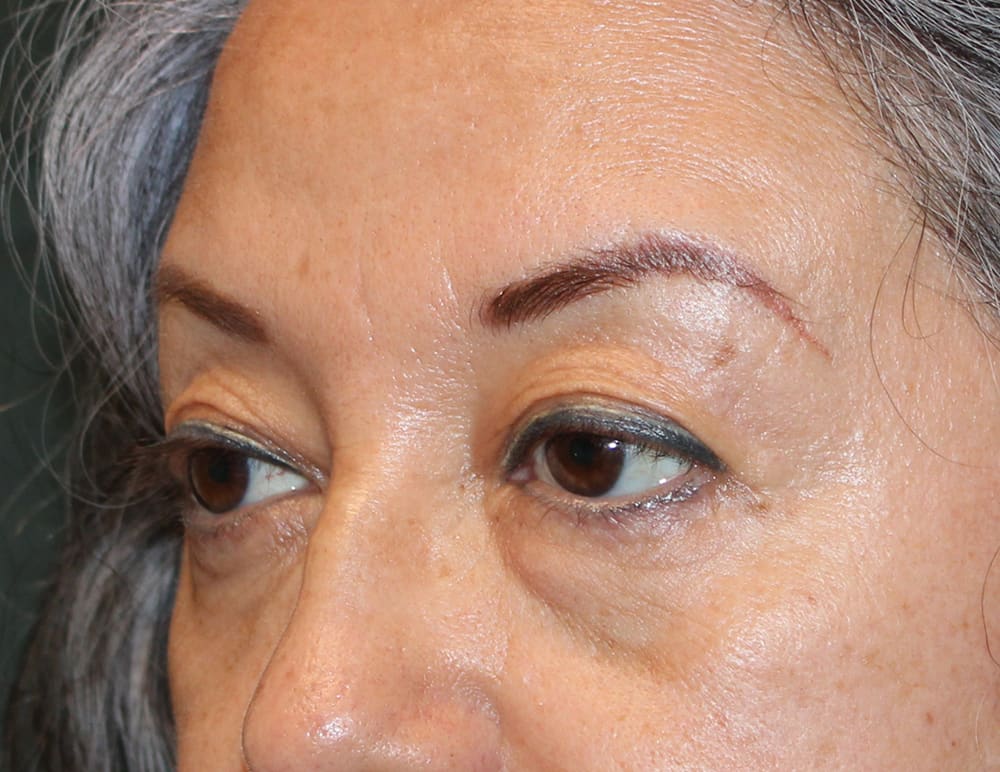 Lower Blepharoplasty Before & After Image