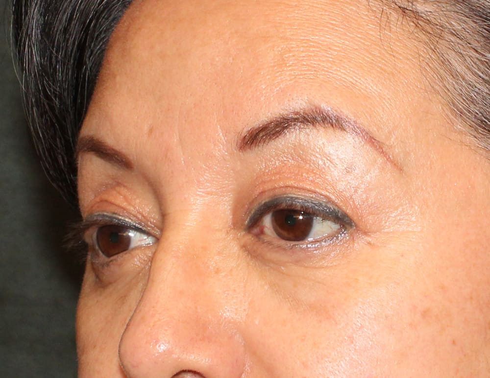 Lower Blepharoplasty Before & After Image