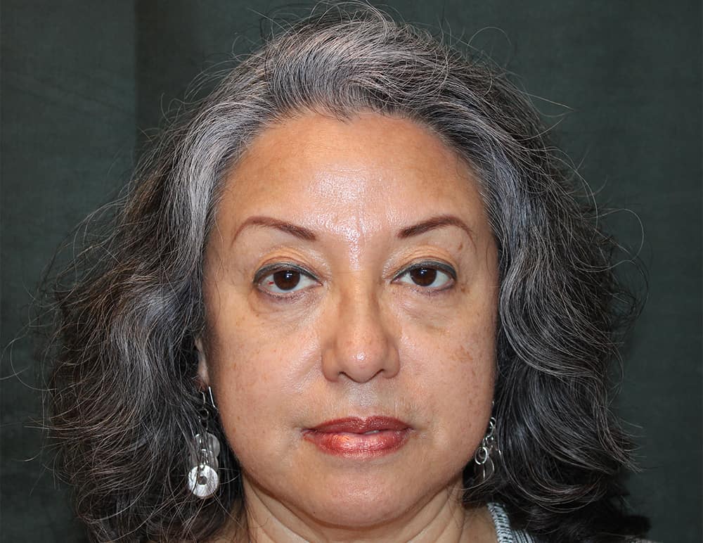 Lower Blepharoplasty Before & After Image