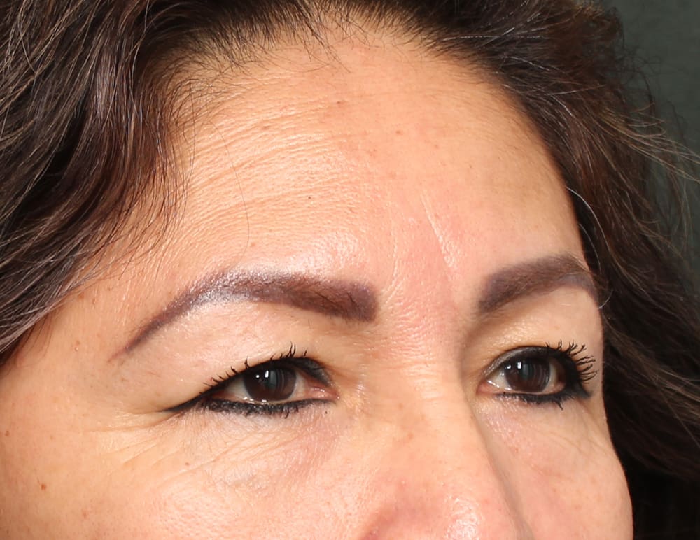 Lower Blepharoplasty Before & After Image