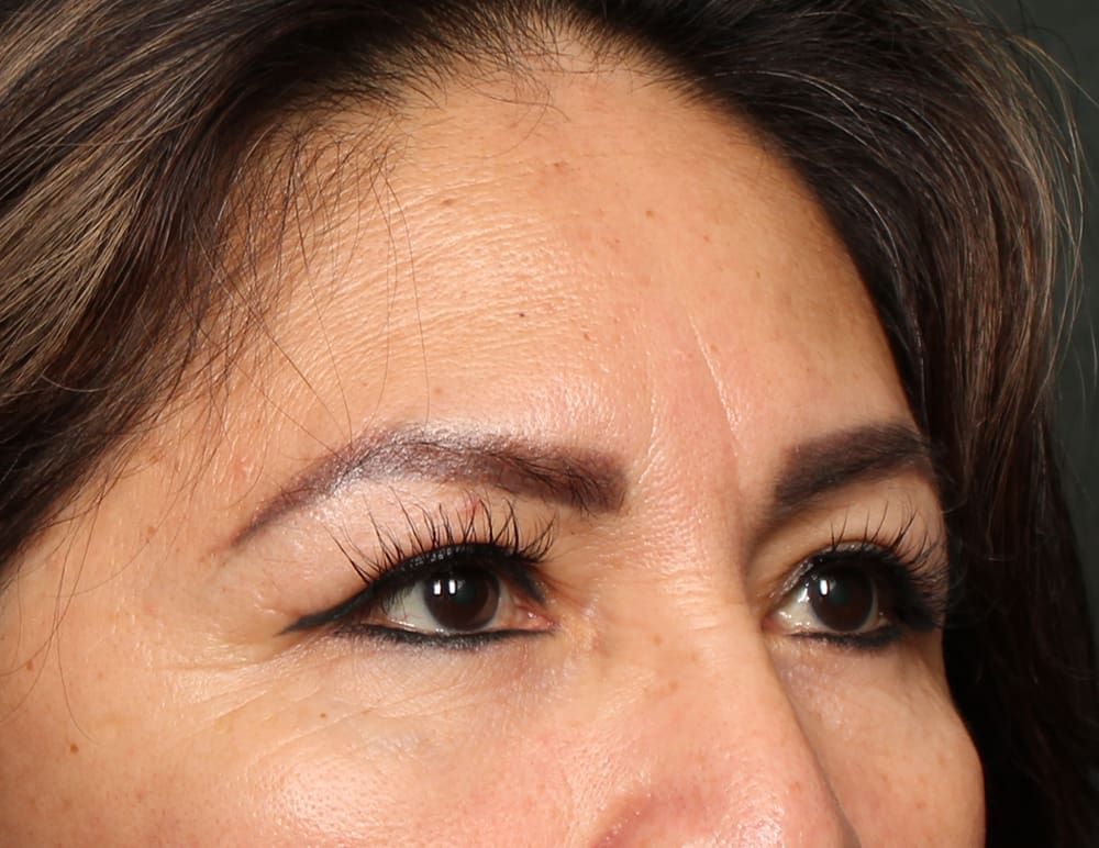 Lower Blepharoplasty Before & After Image