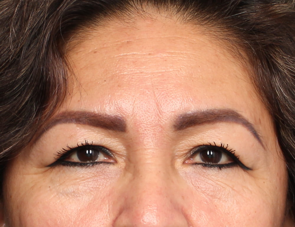 Lower Blepharoplasty Before & After Image