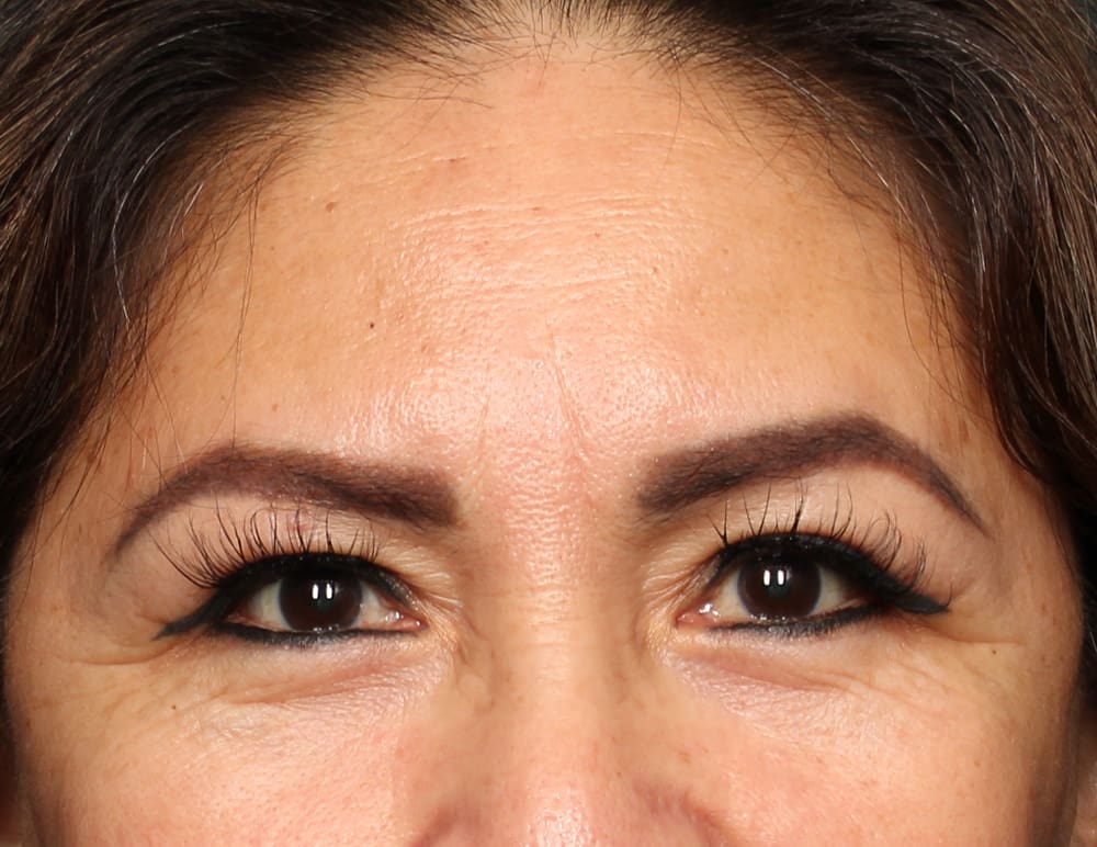 Lower Blepharoplasty Before & After Image