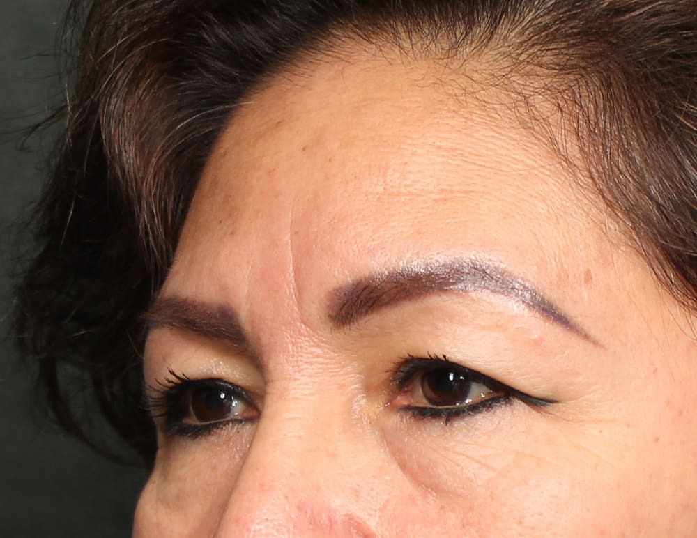 Lower Blepharoplasty Before & After Image