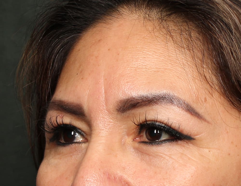 Lower Blepharoplasty Before & After Image