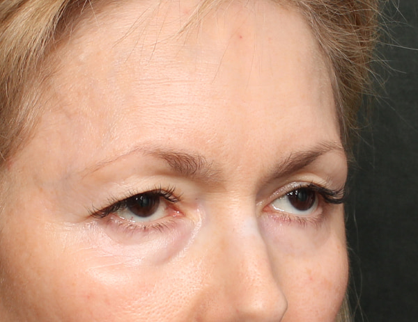 Lower Blepharoplasty Before & After Image