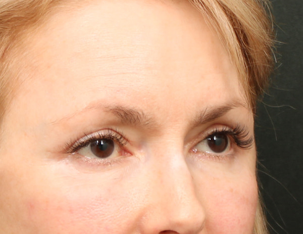 Lower Blepharoplasty Before & After Image