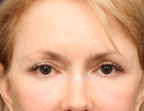 Lower Blepharoplasty Before & After Image