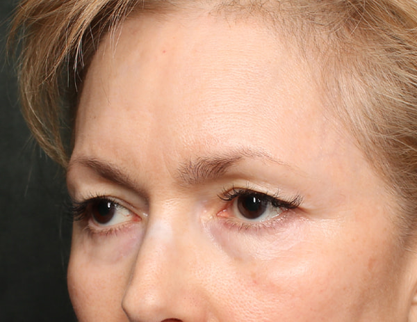 Lower Blepharoplasty Before & After Image