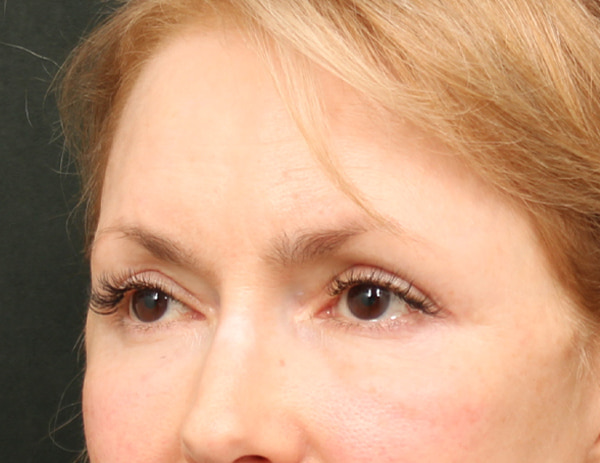Lower Blepharoplasty Before & After Image