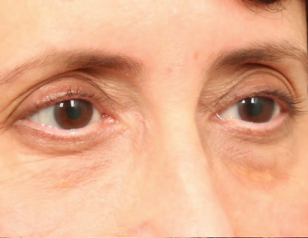 Lower Blepharoplasty Before & After Image