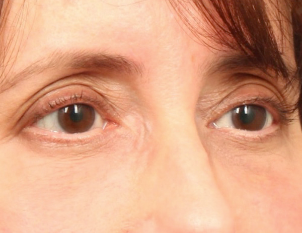 Lower Blepharoplasty Before & After Image